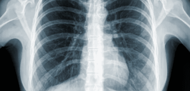 SNUH CXR